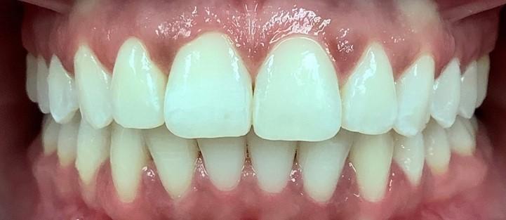 Completed-Clear-Aligner-Treatment-After-Image
