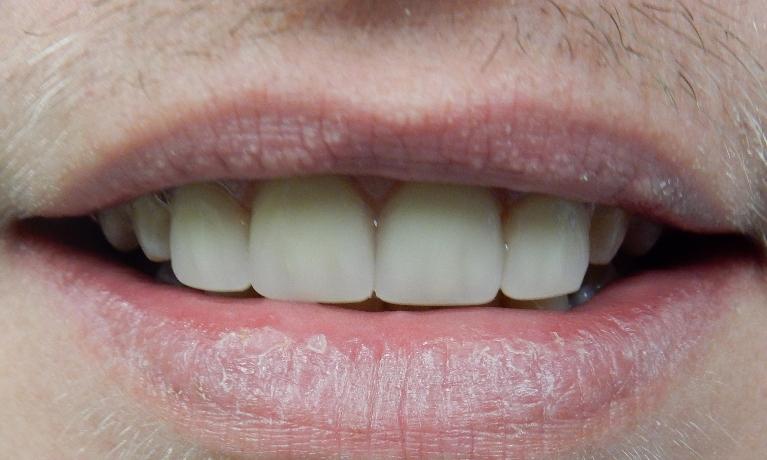 Anterior-Partial-After-Image