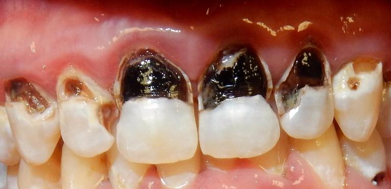 Anterior-Partial-Before-Image