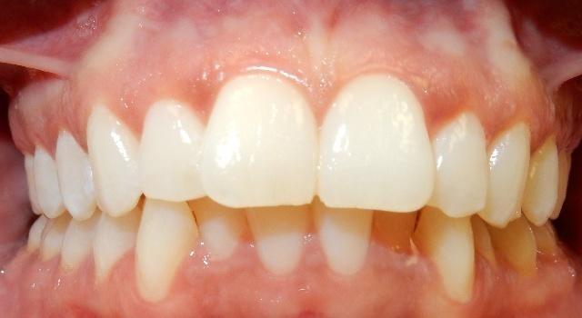 Completed-Clear-Aligner-Treatment-Before-Image